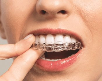 ¿Cómo Funciona el Tratamiento Invisalign?