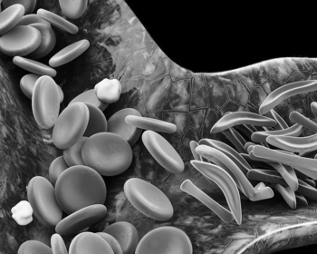 O Futuro É Agora para a Anemia Falciforme